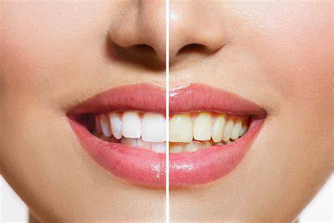 Smile Lume LED Teeth Whitening Kit